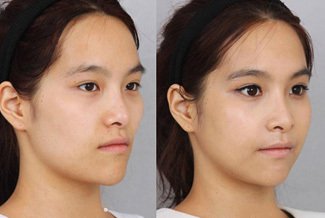 Facial enhancement using Facial Fillers